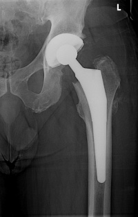 What Type of Hip Replacement Implant Is Best?