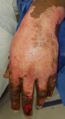 Example of wound edema in hand and fingers