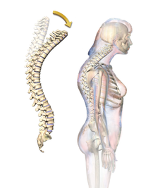 Age-related Hyperkyphosis - Physiopedia