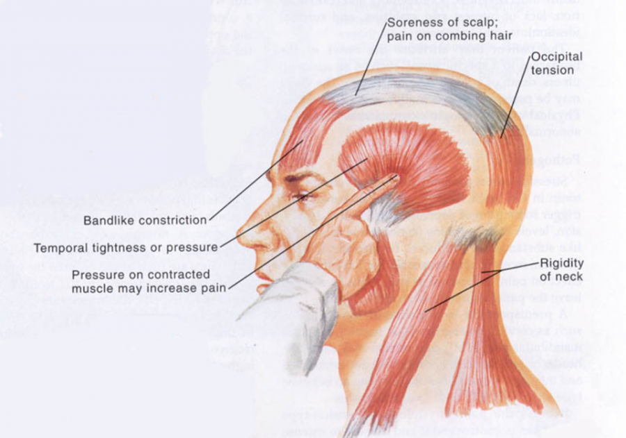 tension-type-headache-physiopedia