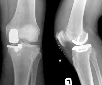 AC Joint Injuries - Robotic Joint Replacement Surgery Centre, Navi