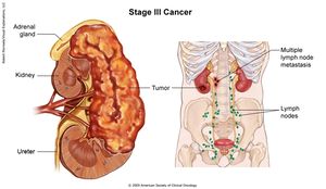 Kidneycancerstage3b.jpg