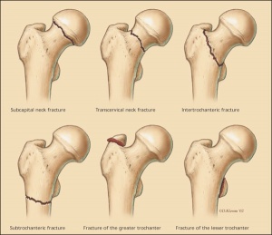 Figure1 hip fracture.jpeg