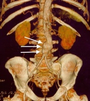 3 Dimensional CT scan imaging showing an AAA