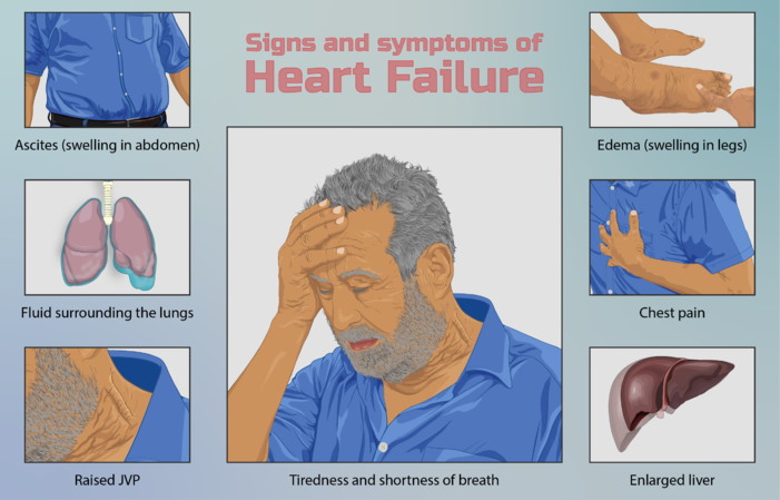 701px Depiction Of A Person Suffering From Heart Failure 