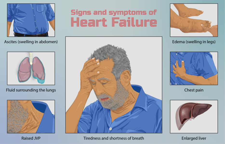 934px Depiction Of A Person Suffering From Heart Failure 
