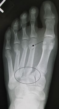 Metatarsal Stress Fractures in the Athletic Population - Physiopedia