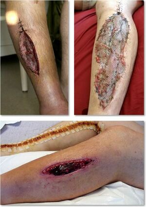 Editing Compartment Syndrome - Physiopedia