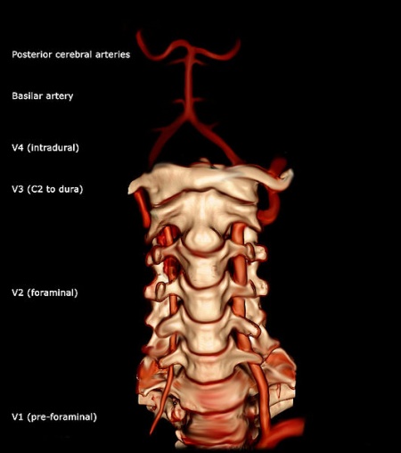 Vertebral Artery Test Physiopedia 7359