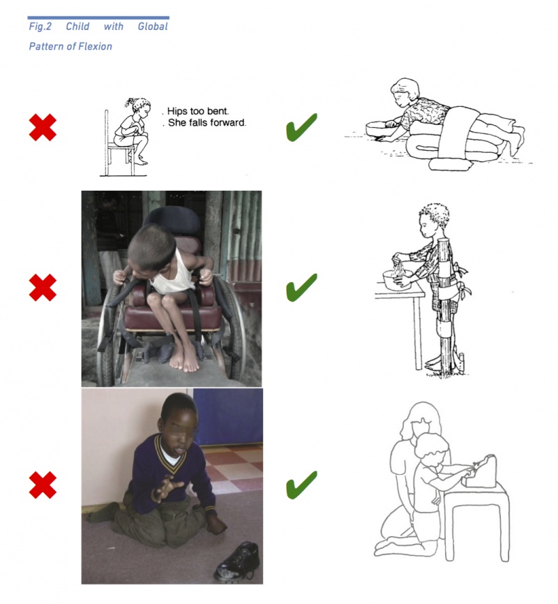 Positioning the Child with Cerebral Palsy - Physiopedia