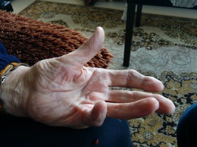 Image 1: Clinical presentation of Dupuytren contracture