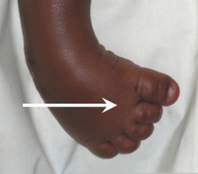 Assessing Children With Clubfoot Physiopedia