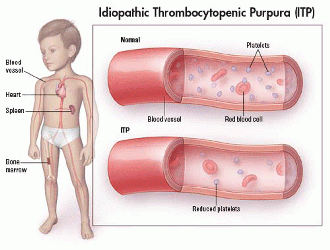 mild idiopathic thrombocytopenic purpura