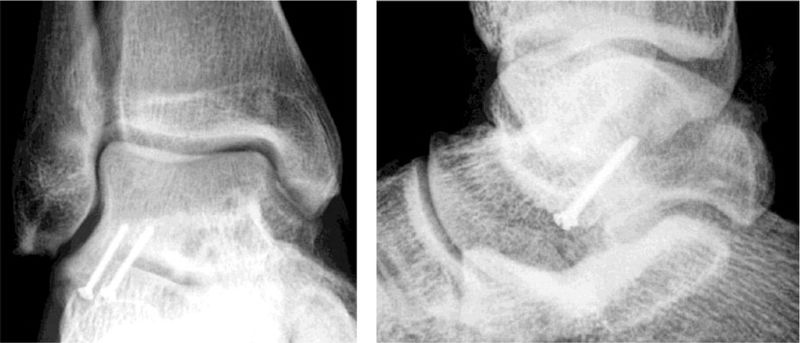 File:Fixation of lateral process fracture.jpeg