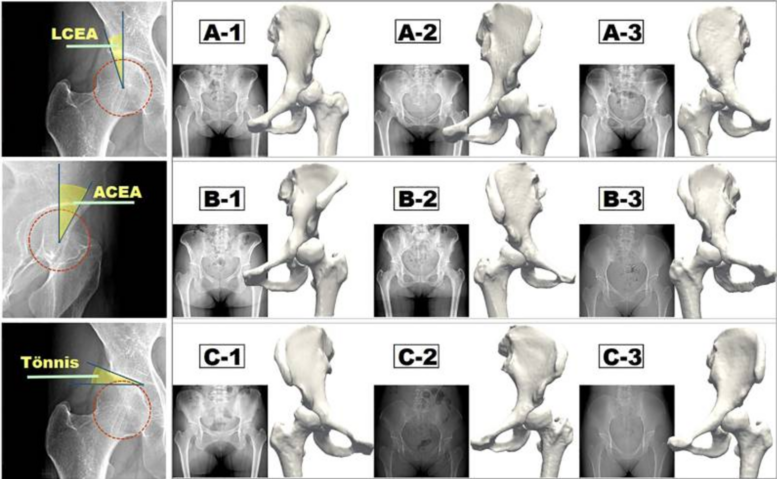 Measurement methods of three major morphological indices (LCEA, ACEA, and Tönnis angle) and the corresponding three groups of reconstructed hip joint models.
