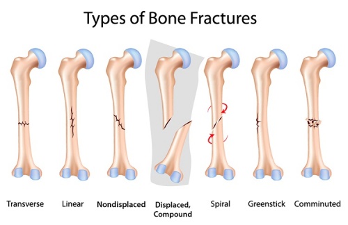 Types of fractures.jpg