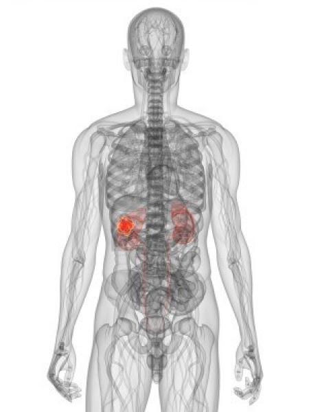 File:Kidney-cancer-imaging.jpg