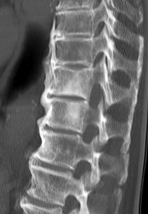 diffuse idiopathic skeletal hyperostosis cervical spine