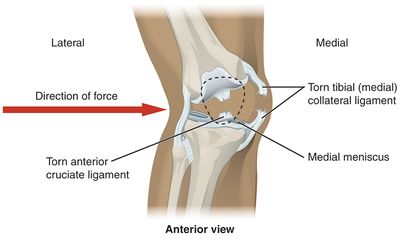 The medial collateral ligament complex consisting of the