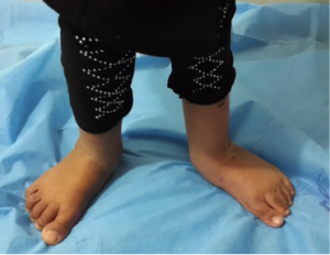 Clubfoot With Post Surgical Relapse Physiopedia