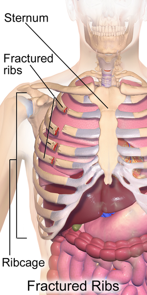 File:Fractured Ribs.png