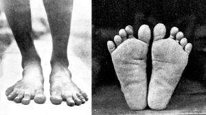 4 Factors That Can Lead to Wide Feet