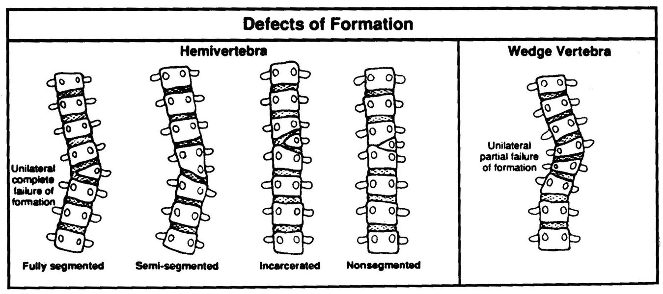 Congenital Spine Deformities Physiopedia 7371