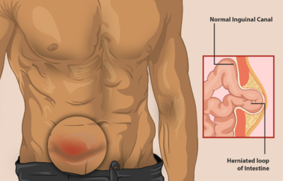 A Complete Guide On Sports Hernia