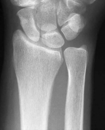 colles fracture xray