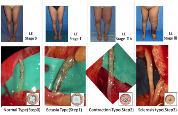 Topical Stimulation for Treating Neuropathy and Lymphedema