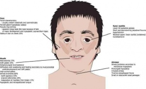 treacher collins syndrome ears