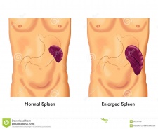 Enlarged-spleen-medical-illustration-symptoms-50334478.jpg