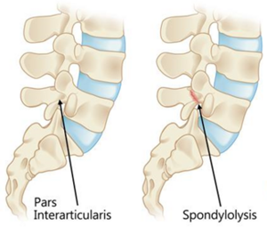 77.2% of lumbar stress fractures occur at the Pars Interarticularis, these fractures are also known as spondylolysis'