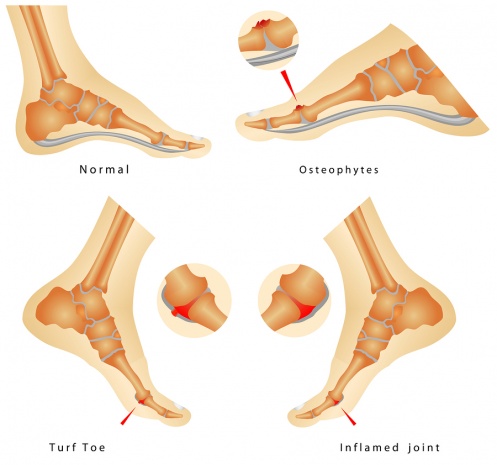 Turf toe - Physiopedia