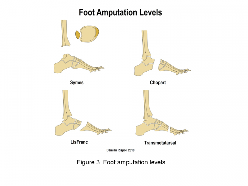 File:Foot amputation levels .png