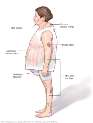 Neck Hump: Symptoms, Diagnosis, Causes, Treatment Exercises 