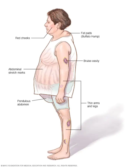 Neck Hump - Physiopedia