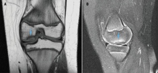 MRI for osteochondral defect.jpg