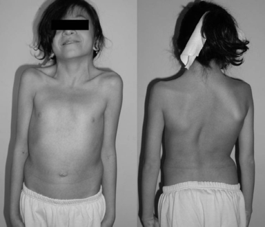 https://www.physio-pedia.com/images/thumb/4/43/12_years_Old_female_with_Noonan_Syndrome.PNG/384px-12_years_Old_female_with_Noonan_Syndrome.PNG