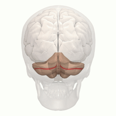 cerebellar vermis atrophy