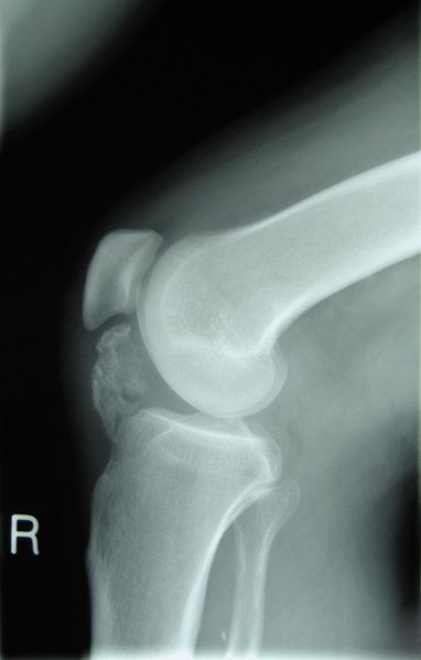 File:Osteochondroma X-ray.jpg