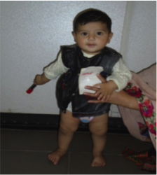 Case Study-Idiopathic Unilateral Clubfoot 5.png