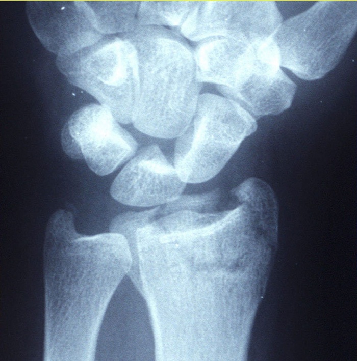 Distal Radial Fractures Physiopedia