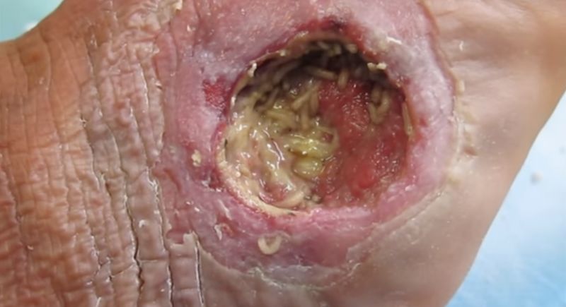 File:Maggot debridement therapy on a diabetic foot.jpg