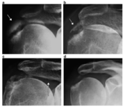 Tendinopathie der Schulter.png