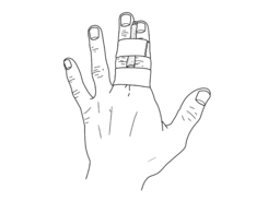 Phalangeal Fractures - Physiopedia