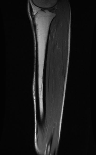 File:Bone stress injury mid-shaft tibia.jpg