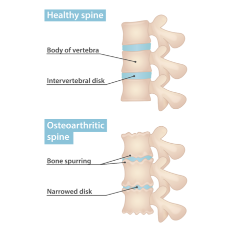 osteoarthritis back