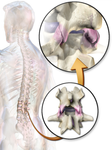 Facet Joint Syndrome Physiopedia