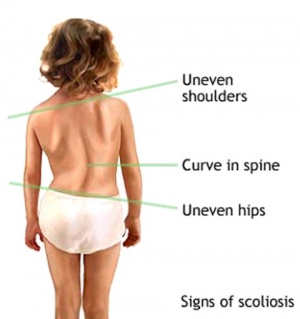 Scoliosis Physical Therapy Bracing and Exercise
